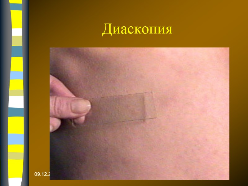 09.12.2017 Диаскопия